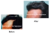 Hair Transplant Image Gallery