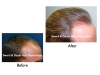 Hair restoration Results