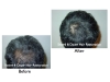 Photos before and after hair restoration results