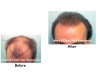Hair Transplant & Hair Restoration Surgery