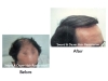 Before and after hair transplant pictures