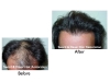 Hair Transplant Image Gallery