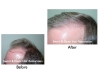 Hair Transplant Before and After Photos