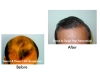 Hair Transplant Before and After Pictures