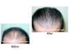 Before and after hair transplant pictures