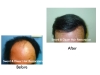 Hair Transplant & Restoration