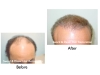 Hair Transplant Before and After Pictures