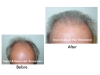 Hair restoration information