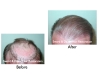 Best Hair Loss Restoration & Transplant