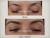 Eyebrow Transplant & Restoration