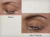 Eyebrow Transplant, Eyebrow Restoration