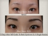 Eyebrow Transplant for Women