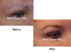 Eyebrow Restoration - Hair Transplant