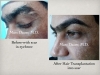 Eyebrow Transplant Surgery