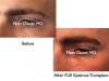 male eyebrow transplant photos