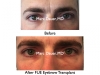 male eyebrow transplant photos