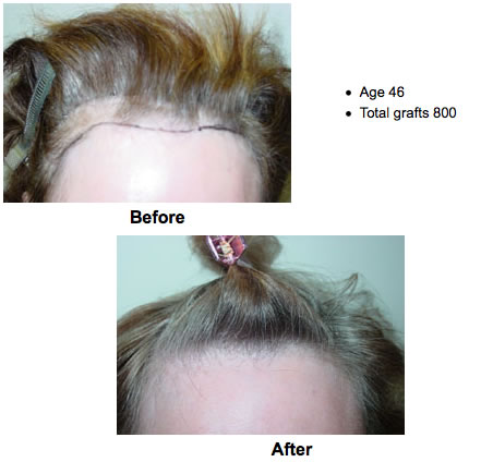 Hair Restoration Surgery | Hair Loss Treatment | Hair Transplant |  Torrance, South Bay, Palos Verdes, Los Angeles, Beverly Hills