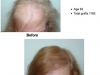 Hair Transplant and Hair Loss in Women
