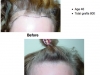 Hair Replacement for Women