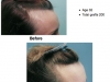 Hair Replacement Surgery/Hair Transplant