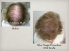 Hair Transplant Women: Before After Photos