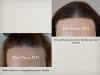 Hair Loss Treatment & Replacement for Women