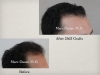 Hair Transplant Photos Gallery