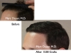 Hair Transplant Before & After Pictures