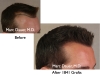 Hair Transplant Before After Photos Results