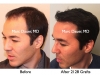 Hair Transplant Before and After Photo
