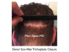 Hair Transplant Photos
