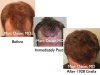 hair transplant before and after photos