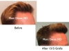 Norwwod 4 Before and After Hair Transplant Photos