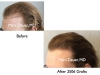 Before and After Photos for Hair Replacement