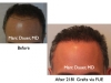 Photos before and after hair transplant results