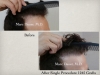 Hair Transplants Pictures