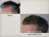 Hair Restoration & Hair Transplant