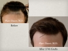 Hair Transplantation Results