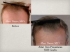 Hair Transplant (Restoration) Pictures