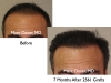 Hair Restoration Hair Loss Treatments for Men