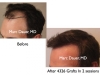 hair-transplant-slides2-235