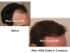 hair-transplant-slides2-236