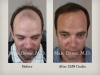 Hair Transplant before and after Pictures