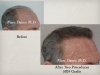 Hair restoration Before and After Photos