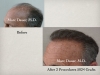 Photos before and after hair restoration results